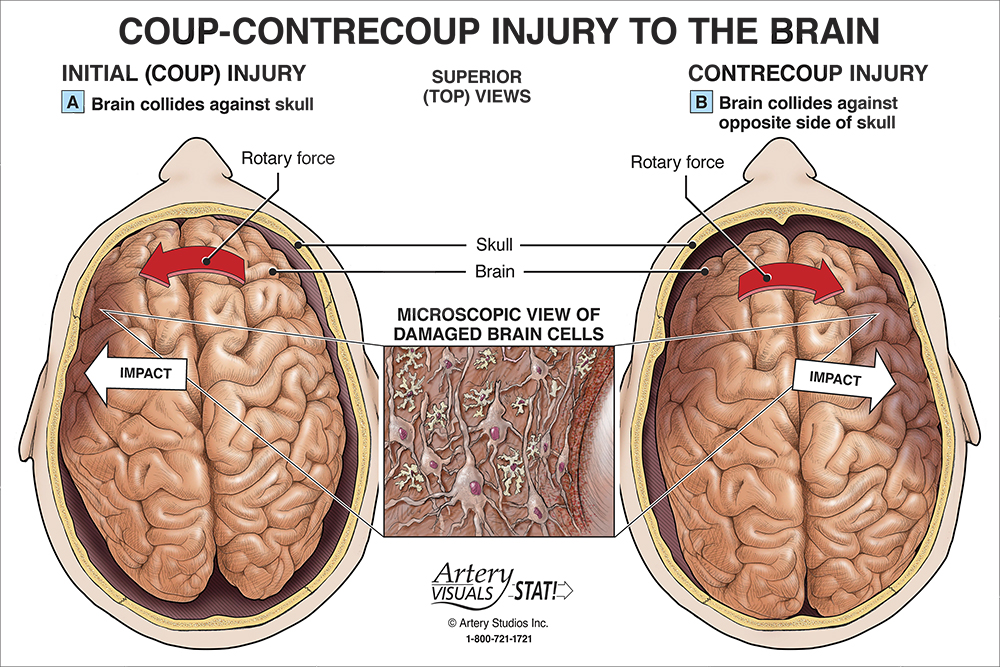 Coup-Contrecoup Injury to the Brain